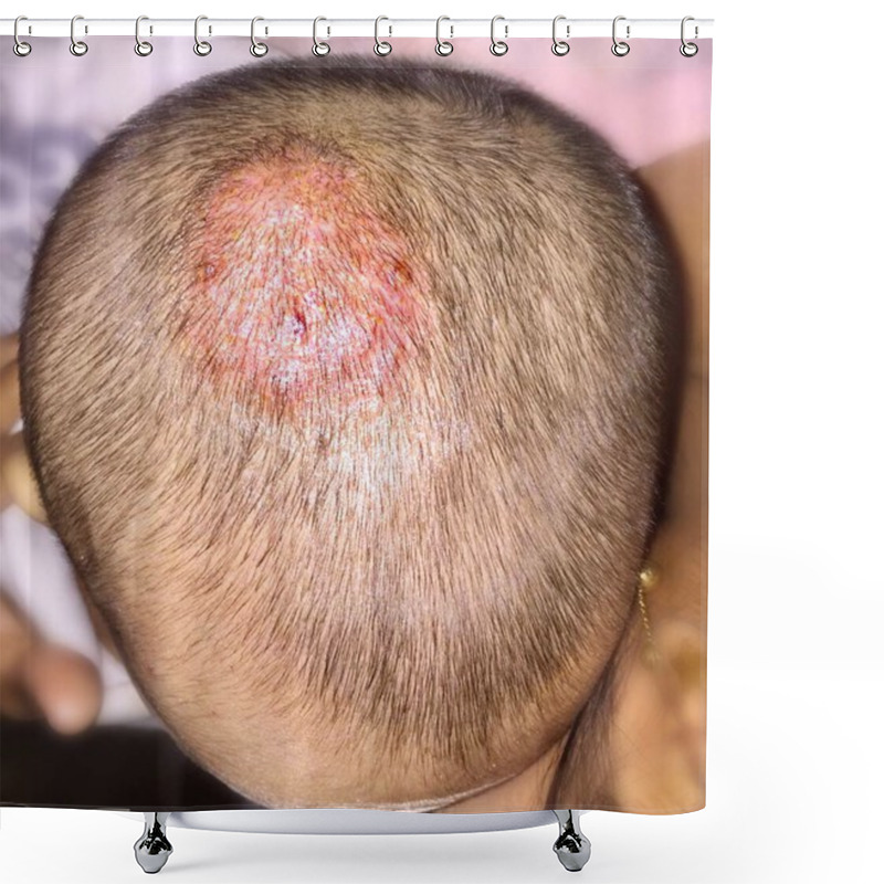 Personality  Treated Tinea Capitis Or Fungal Infection On Scalp Of Southeast Asian, Burmese Two Years Old  Child In Clinic Shower Curtains