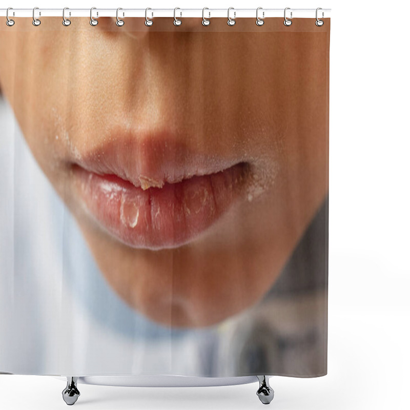 Personality  Closeup Of Chapping Dry Lips And Cracked Skin Around The Mouth Of A Young Boy Shower Curtains