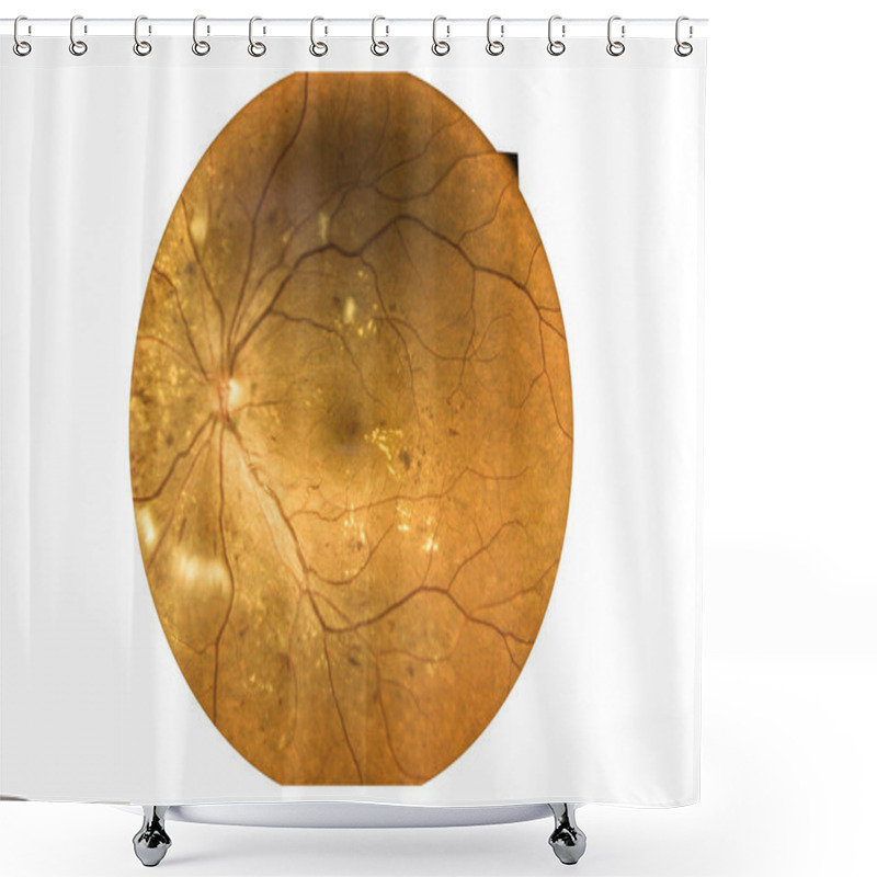 Personality  Fundus Photography Madical Retina Abnormal Isolated On White Background.Retina Of Diabetes Check Up Medical Healthcare Concept. Shower Curtains