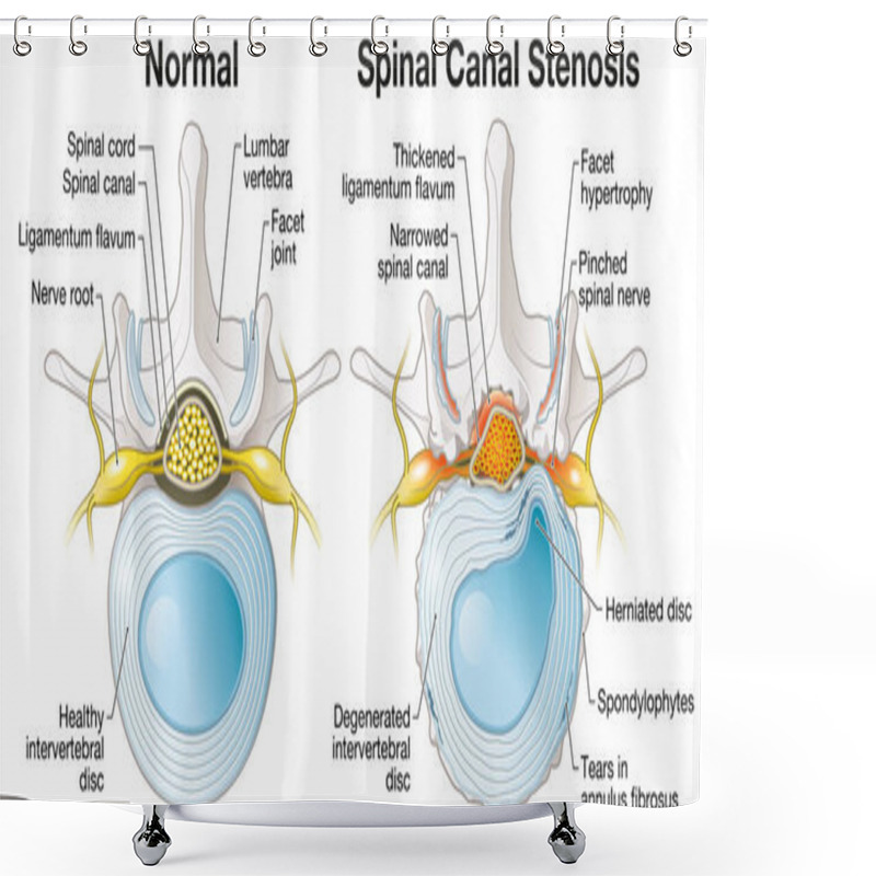 Personality  Illustration Showing Spinal Canal Stenosis Lumbar Vertebra With Intervertebral Disc And Herniated Nucleus Pulposus Shower Curtains