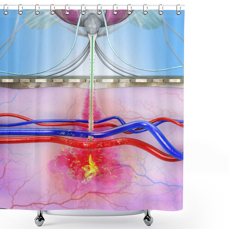 Personality  A Malaria-infected Mosquito Transmits Malaria Pathogens To The Human Bloodstream During Mosquito Bites - 3D Illustration Shower Curtains