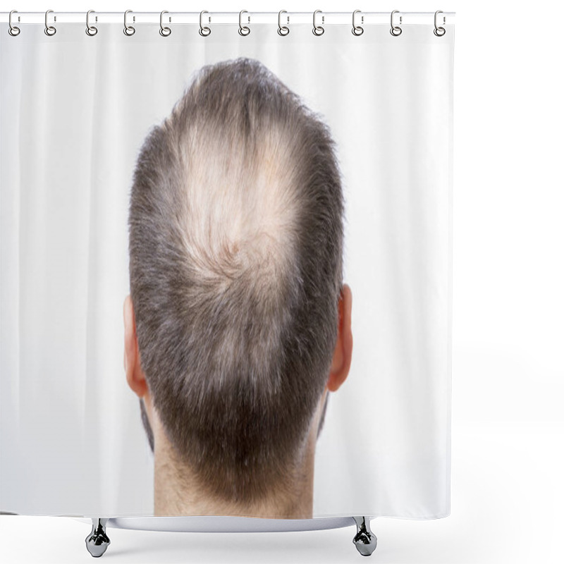 Personality  Bald Man Has A Problem Of Head Baldness And Hair Loss  Shower Curtains