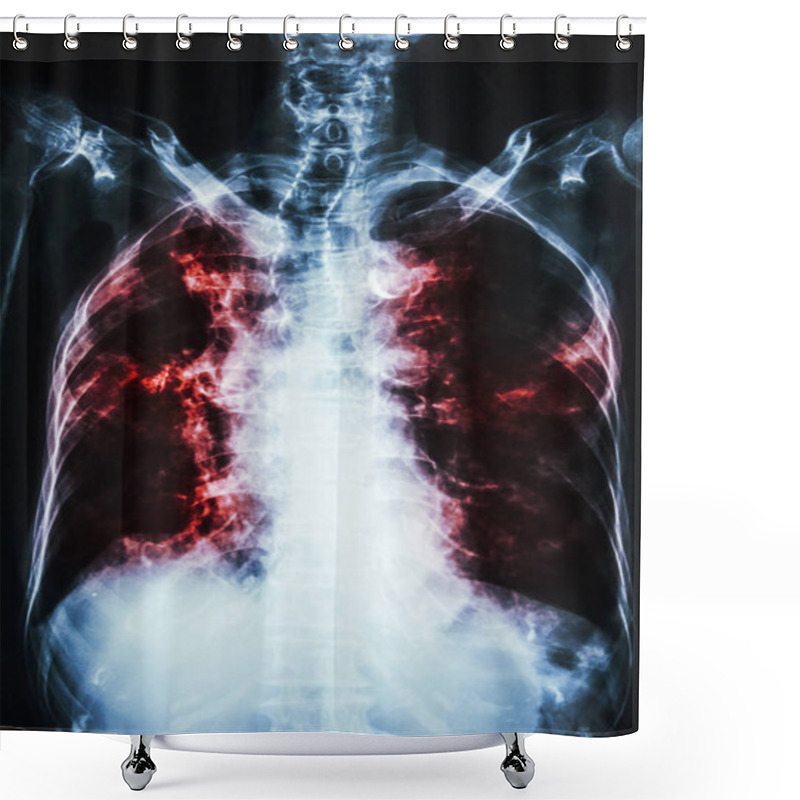 Personality  Pulmonary Tuberculosis . Film Chest X-ray Of Old Patient Show Interstitial Infiltration Both Lung And Calcification At Trachea ( Can Seen Shape Of Trachea ) Shower Curtains