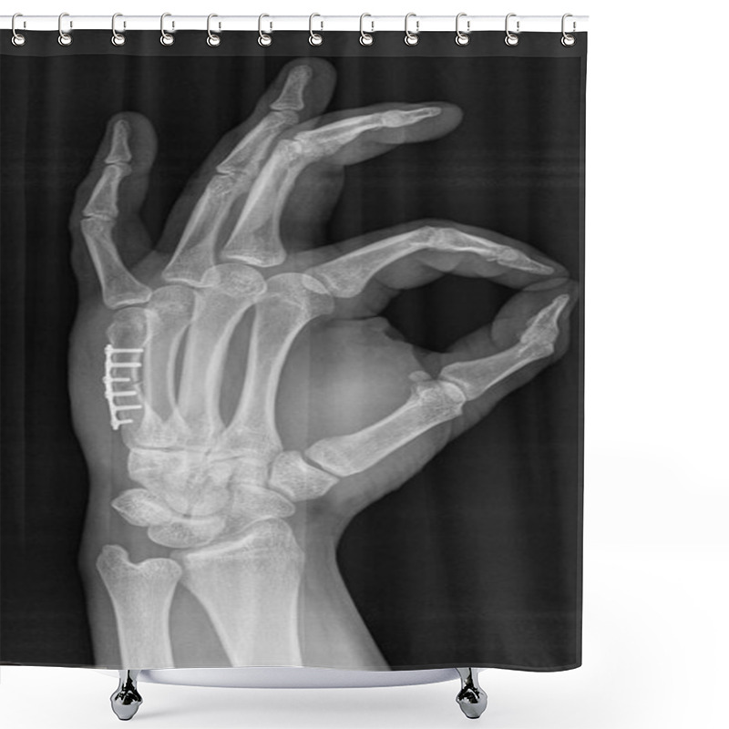 Personality  X-ray Of Human Hand. V Metacarpal Bone With Implant. Shower Curtains