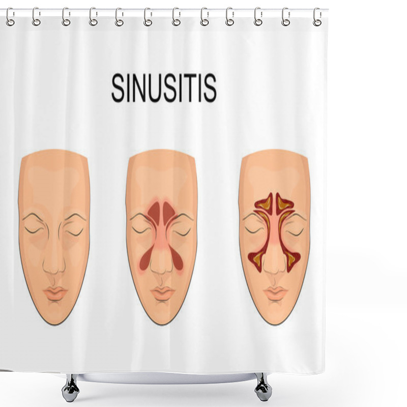 Personality  Nasal Sinus. Inflammation Shower Curtains