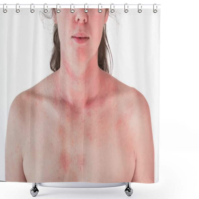 Personality  Allergic skin reaction on the female neck and face - red rash shower curtains