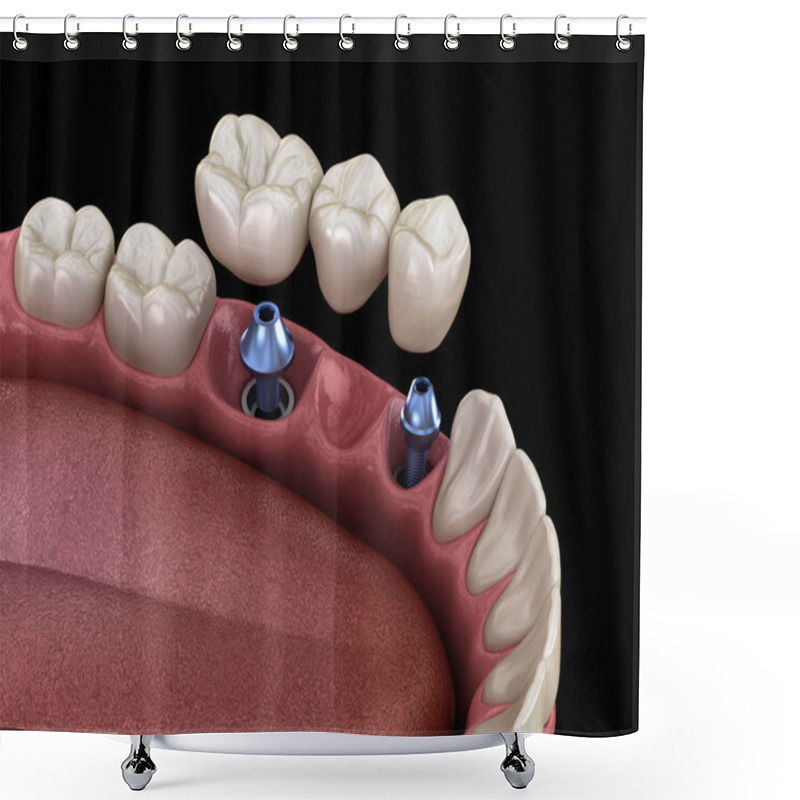 Personality  Dental Bridge Supported By Implants. Medically Accurate 3D Illustration Of Human Teeth And Dentures Concept Shower Curtains