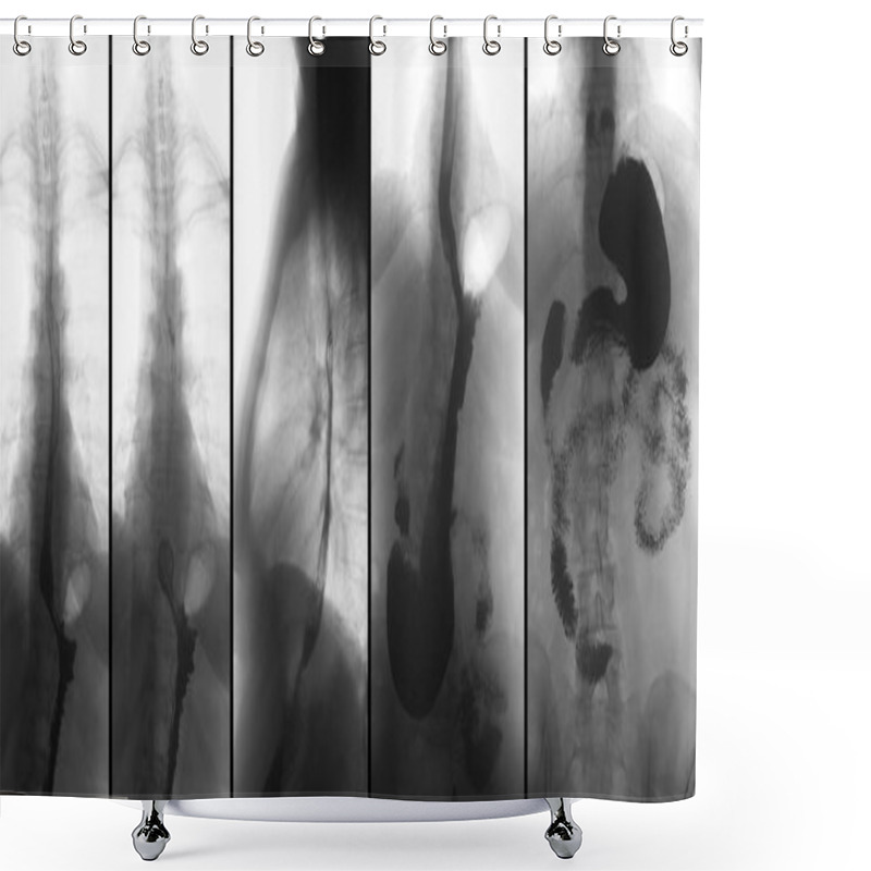 Personality  X-ray Of The Upper Gastrointestinal Tract (UGI) With Barium. Hiatal Hernia. Negative.  Shower Curtains