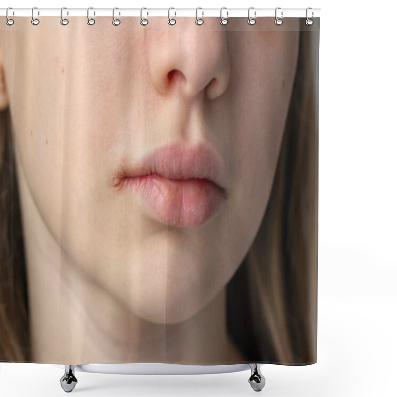 Personality  Close-up Of Chapped Lips With Irritation. Detailed Close-up Of A Young Persons Chapped Lips With Visible Irritation And Dryness Near The Mouth Corner, Highlighting Skin Issues Shower Curtains