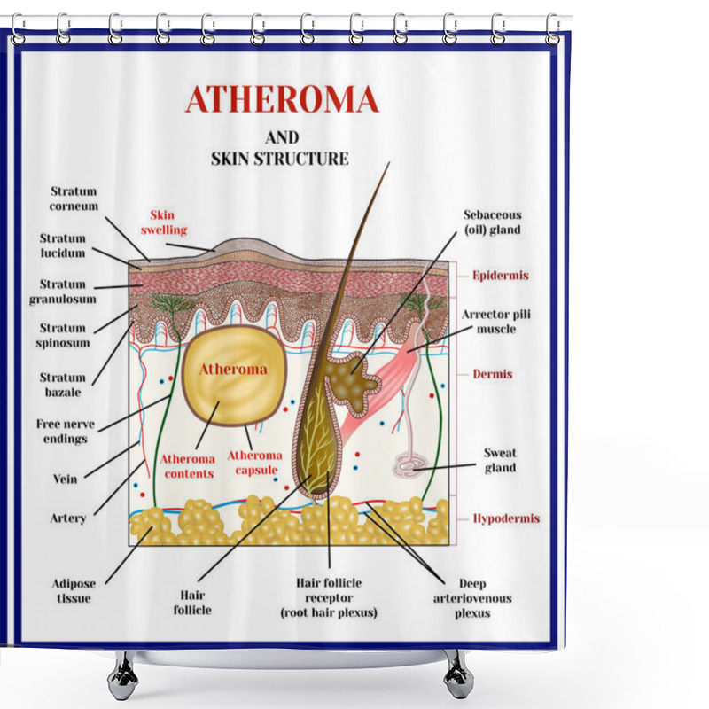 Personality  Atheroma. Cysts, Tumors. Shower Curtains