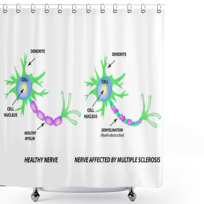 Personality  The Destruction Of The Myelin Sheath On The Axon. Damaged Myelin. Neuron Affected By Multiple Sclerosis. World Multiple Sclerosis Day. Infographics. Vector Illustration On Isolated Background. Shower Curtains