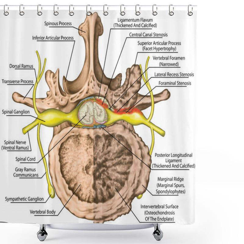 Personality  Central Lateral Stenosis, Second Lumbar Vertebra, Nervous System, Spinal Cord, Lumbar Spine, Nerve Root, Advanced Uncovertebral Arthrosis Of The Lumbar Vertebra, Degenerative Changes Vertebra, Osteophytes, Spondylophytes, Osteoarthritis Of The Joints Shower Curtains