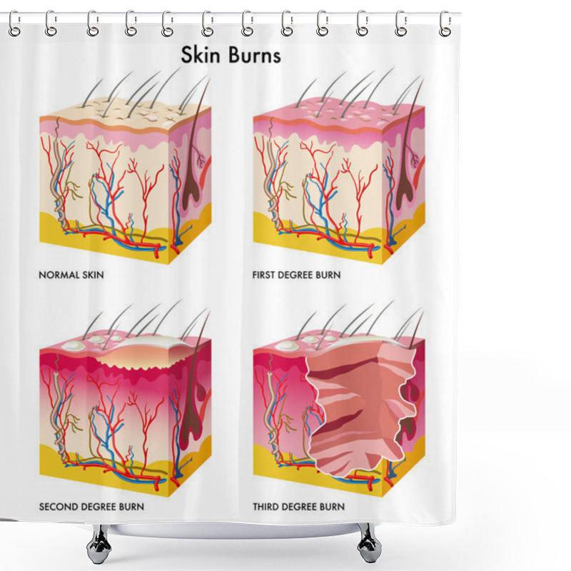 Personality  Medical Illustration Of The Formation Of Skin Burns Shower Curtains