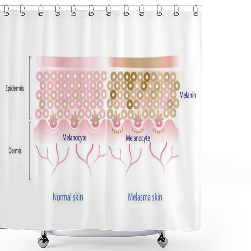 Personality  Normal Skin Layer And Melasma Skin Layer Vector, Melanocyte, Melanin, Melanogenesis Vector On White Background. Shower Curtains